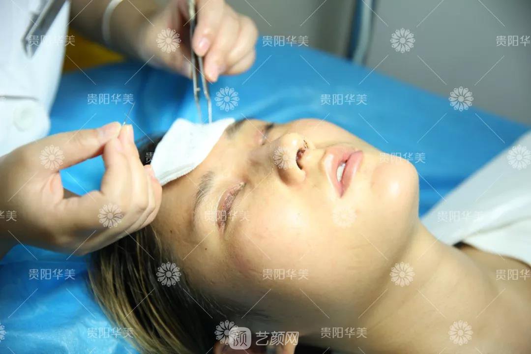 貴陽(yáng)華美謝占軍割雙眼皮+隆鼻真人案例圖分享