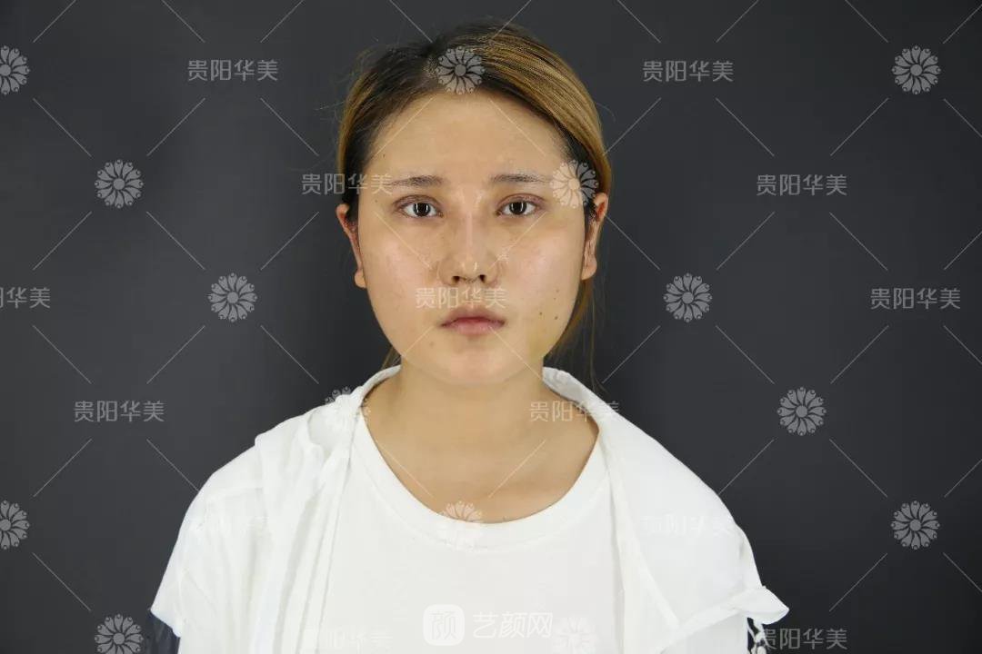 貴陽(yáng)華美謝占軍割雙眼皮+隆鼻真人案例圖分享