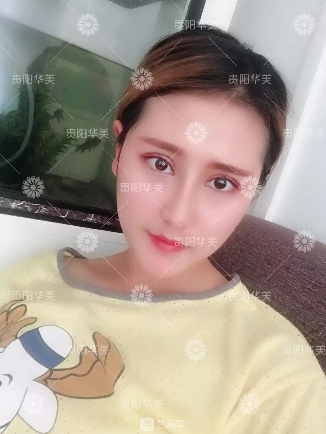 貴陽(yáng)華美謝占軍割雙眼皮+隆鼻真人案例圖分享