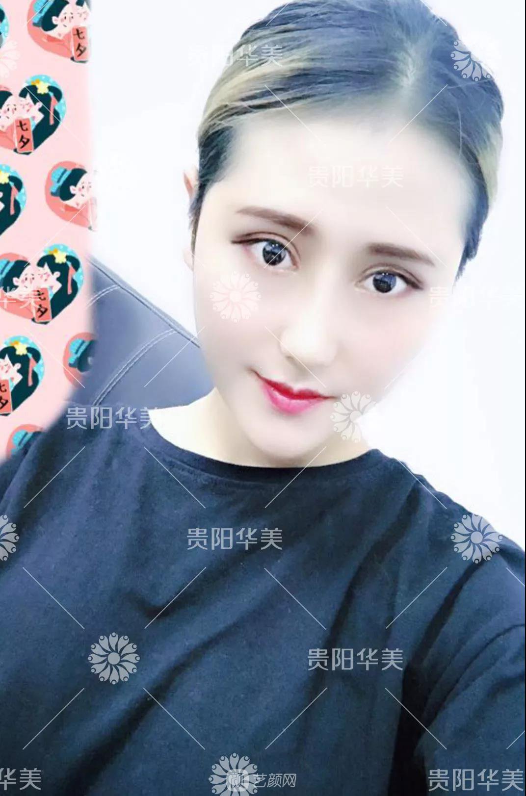 貴陽(yáng)華美謝占軍割雙眼皮+隆鼻真人案例圖分享