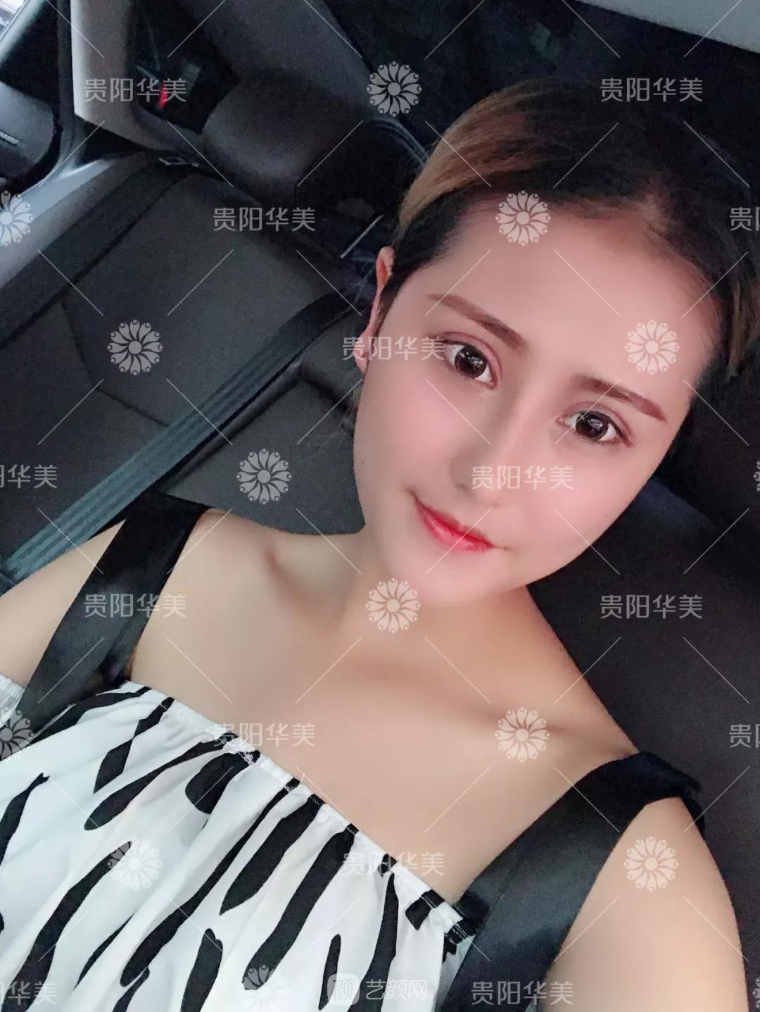 貴陽(yáng)華美謝占軍割雙眼皮+隆鼻真人案例圖分享