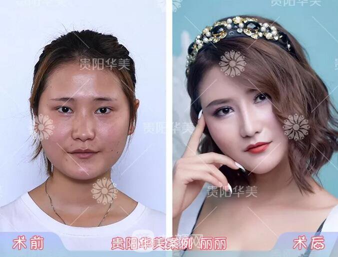 貴陽(yáng)華美謝占軍割雙眼皮+隆鼻真人案例圖分享