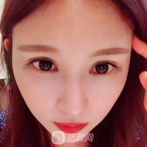 成都銅雀臺(tái)雷剛雙眼皮修復(fù)案例分享，半個(gè)月果圖~