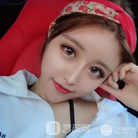 成都銅雀臺(tái)雷剛吸脂瘦臉一個(gè)月案例分享~