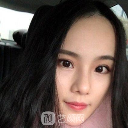 重慶聯(lián)合麗格王巖玻尿酸隆鼻三個(gè)月了，分享果照片~