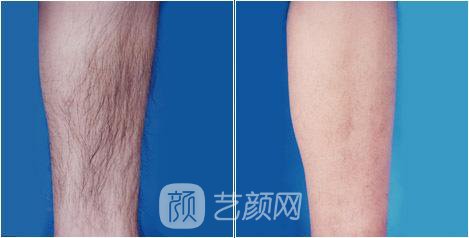 溫州激光脫毛一般要多少錢？