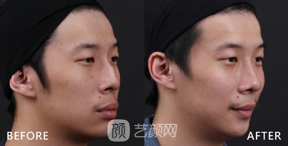 武漢駝峰鼻矯正費(fèi)用大概多少？
