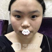 成都美容整形醫(yī)院馮春雨做硅膠隆鼻+假體墊下巴日記一則~