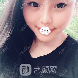 成都美容整形隆鼻+下巴整形真實(shí)案例恢復(fù)圖