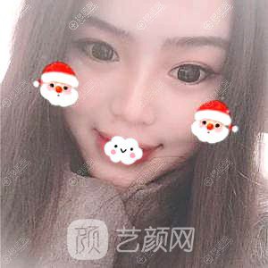 四川隆鼻哪家醫(yī)院好？成都成美馮春雨硅膠隆鼻+假體墊下巴恢復(fù)果圖