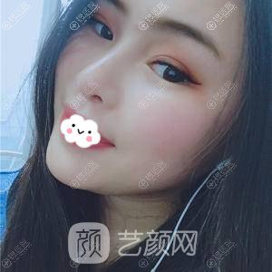 成都成美美容整形醫(yī)院假體隆鼻+墊下巴術(shù)后3個(gè)月果
