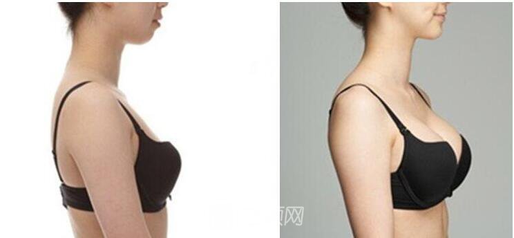 做雪藍(lán)貝假體隆胸能維持多長時(shí)間