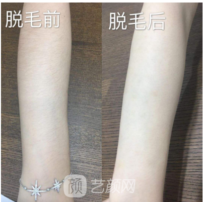 深圳翠綠寶石激光脫毛如何？我們一起來了解一下