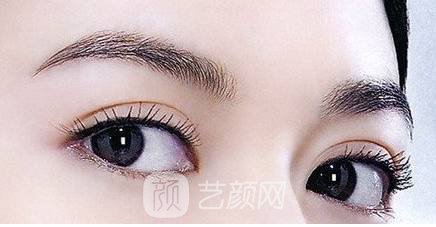 雙眼皮兩個(gè)月，是這個(gè)樣子的，大家來看看