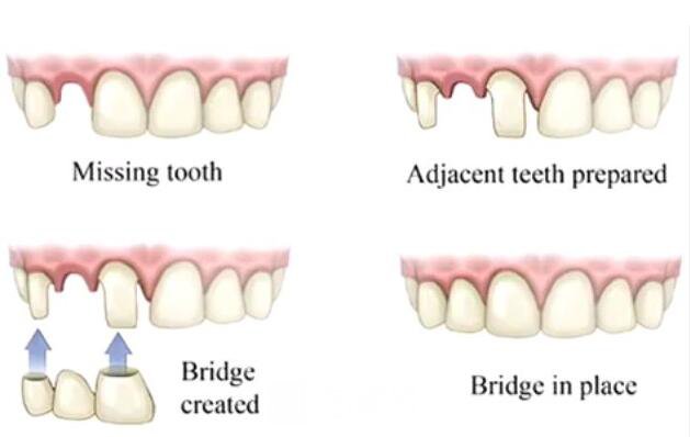 做容冠，牙齒整齊又漂亮~