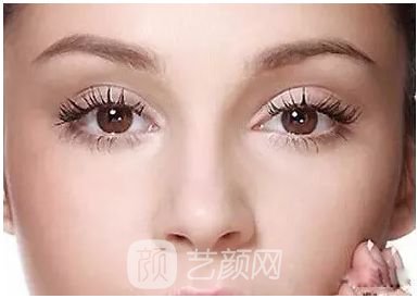 做完雙眼皮兩個月，簡直跟換了個人似的