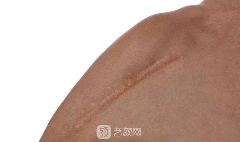 杭州激光去疤費(fèi)用，多久見(jiàn)