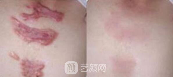 杭州激光去疤費(fèi)用，多久見(jiàn)