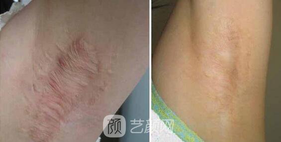 杭州激光去疤費(fèi)用，多久見(jiàn)