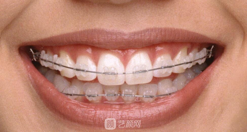 衡陽(yáng)市牙齒整形選哪家醫(yī)院好