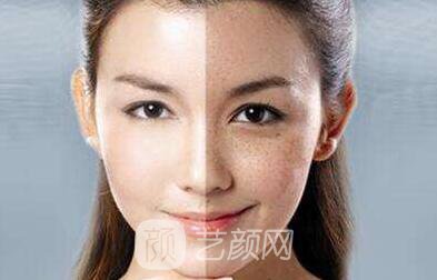 湖南激光祛斑好嗎？