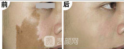 湖南激光祛斑好嗎？