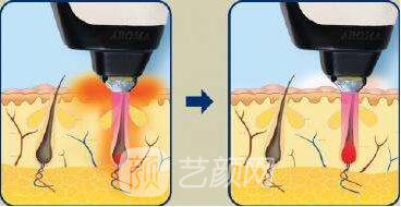 蘭州醫(yī)院激光脫毛多少錢(qián)