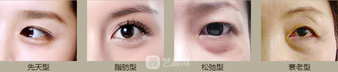 洛陽(yáng)做眼袋哪里好，費(fèi)用如何