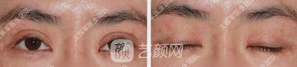 修復(fù)眼睛術(shù)前情況