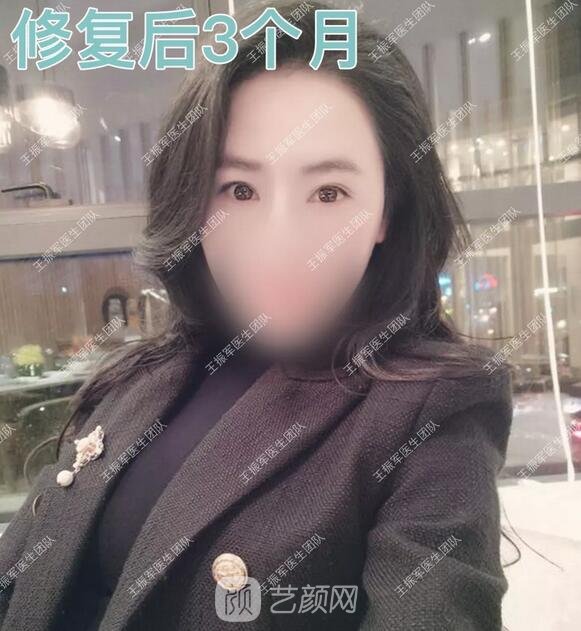 雙眼皮修復(fù)后3個月