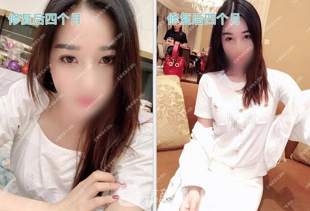 修復(fù)術(shù)后四個(gè)月果圖