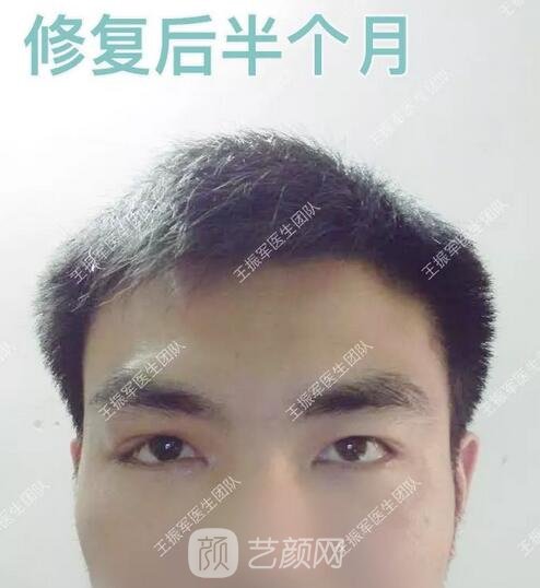 術(shù)后半個(gè)月果