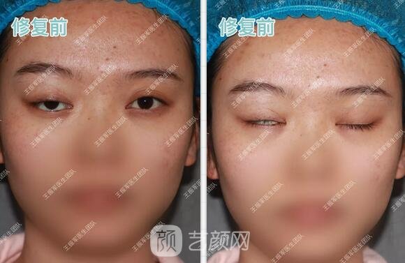 雙眼皮修復(fù)術(shù)前