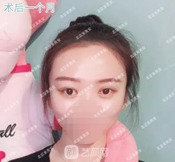 術(shù)后一個(gè)月果