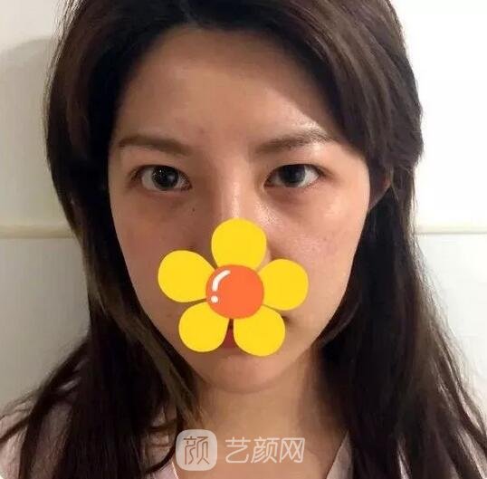 雙眼皮手術術前額頭扁平蘋果肌凹陷內雙