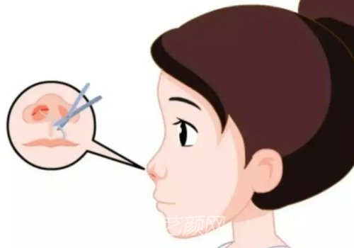 李勁良做鼻子價格是多少